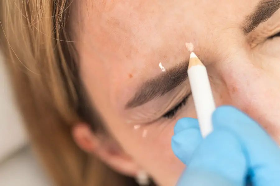 Vyznačení bodů před aplikací botulo. preparátu v oblasti nad obočím