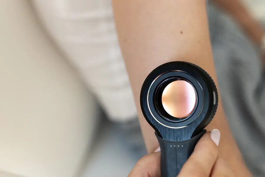 Vyšetření znaménka na paži dermatoskopem