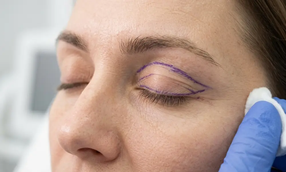 Plastika horních víček (blefaroplastika)